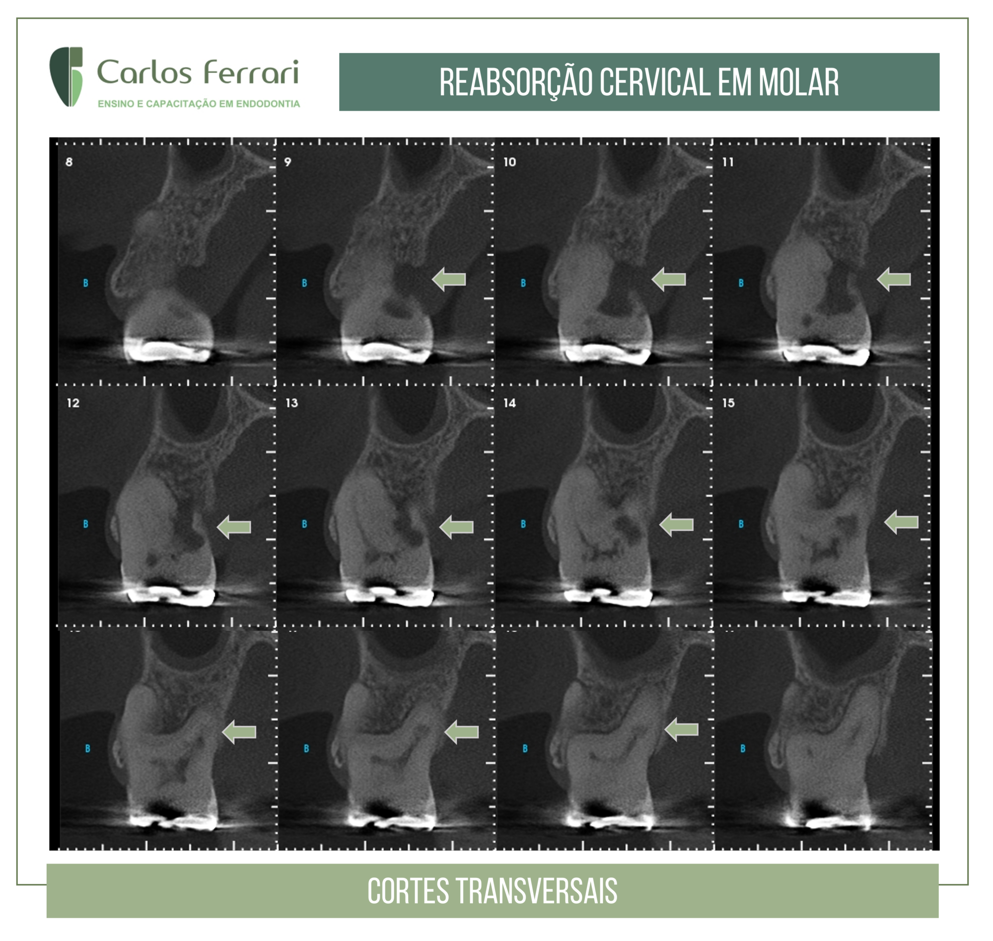 Reabsorção cervical.
