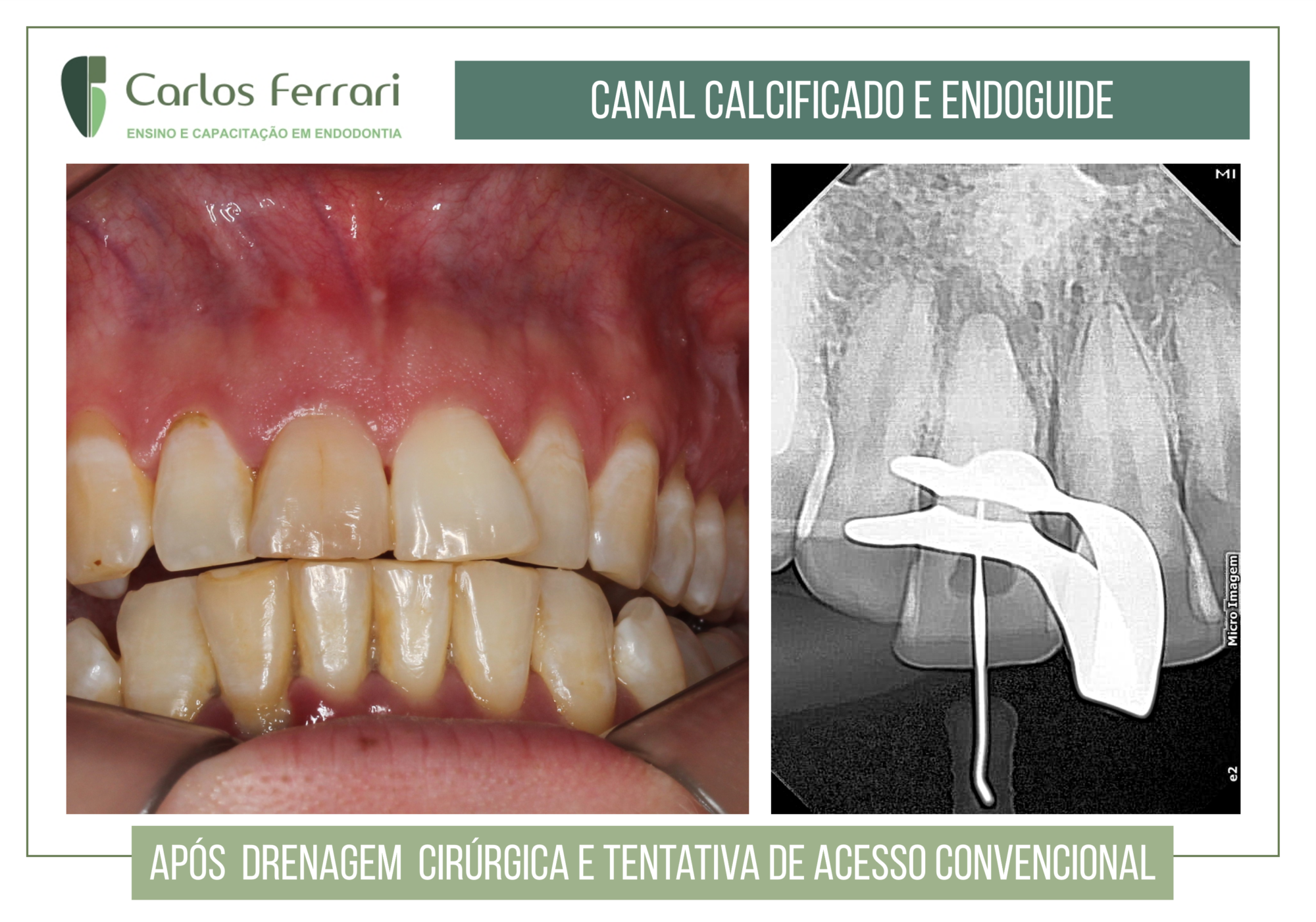 Endoguide em canal calcificado