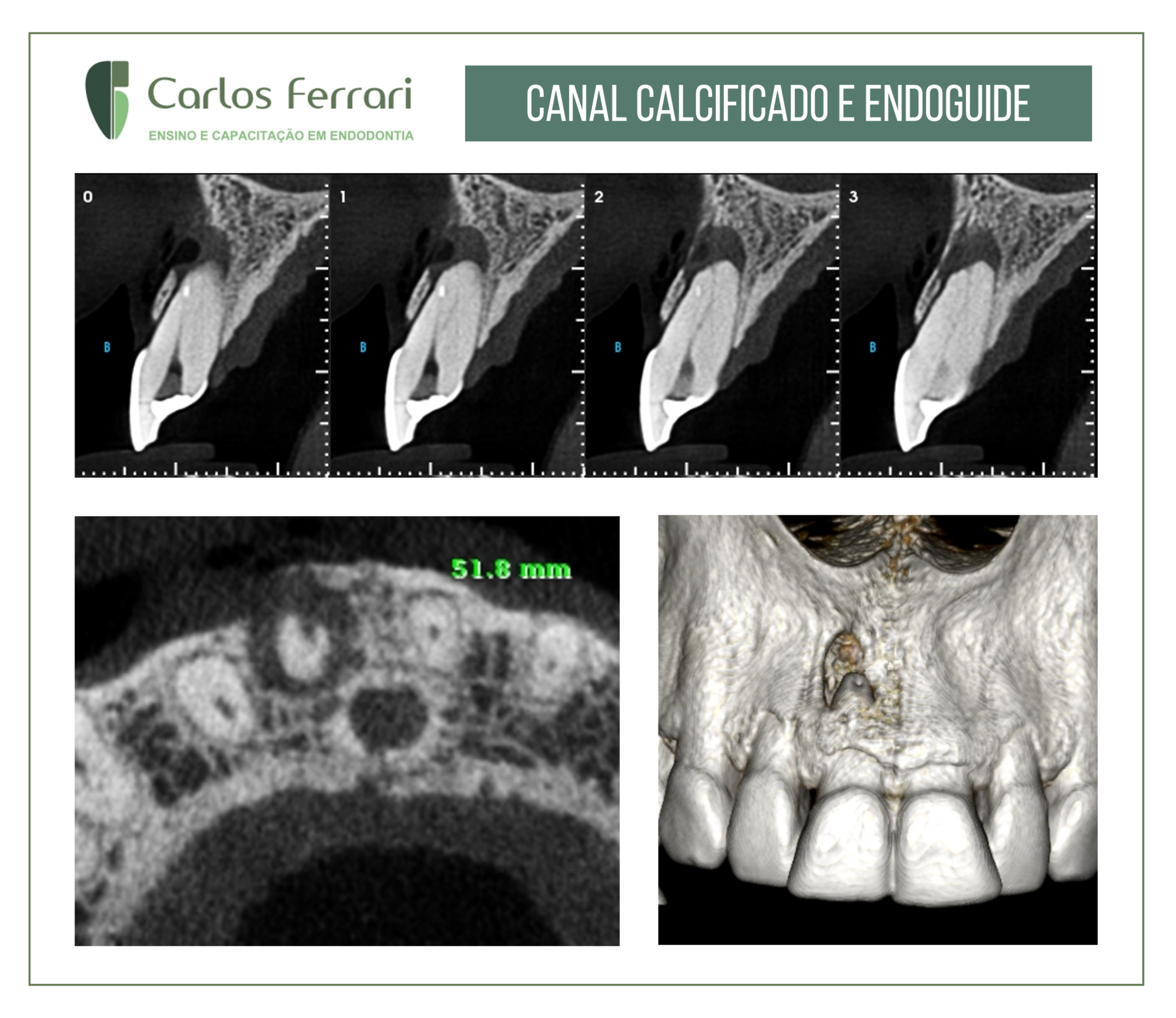 Endoguide em canal calcificado