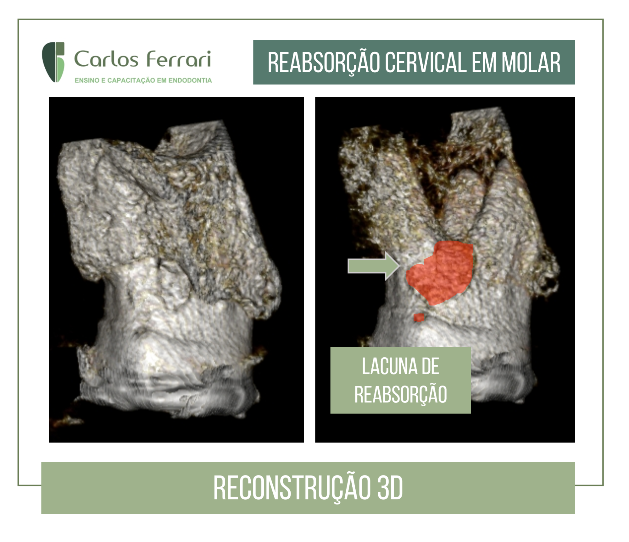 Reabsorção cervical.