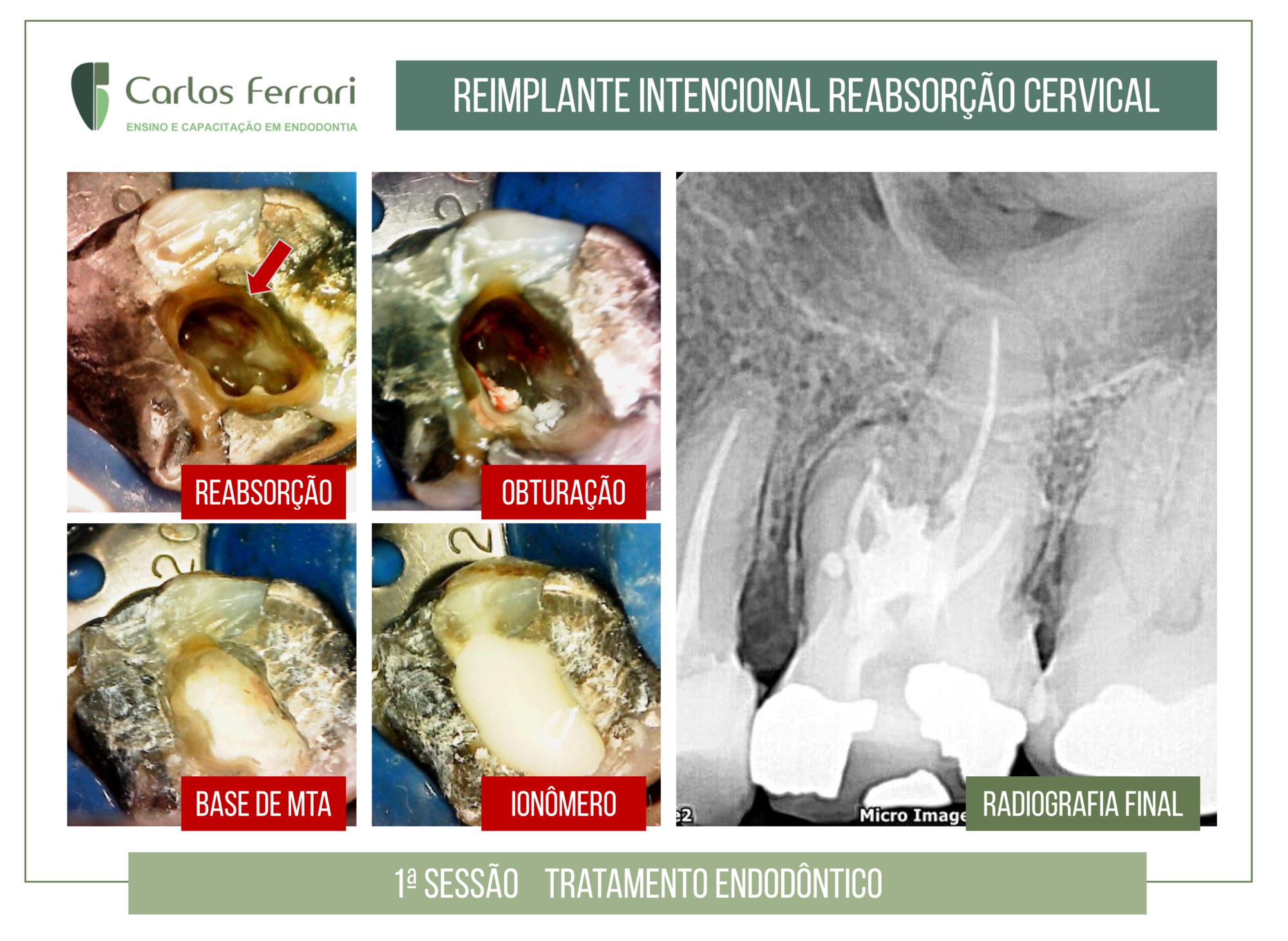 Reimplante intencional em molar com reabsorção radicular.