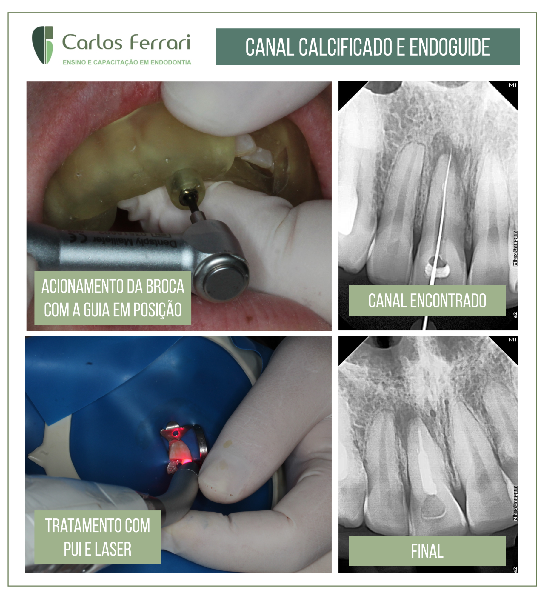 Endoguide em canal calcificado