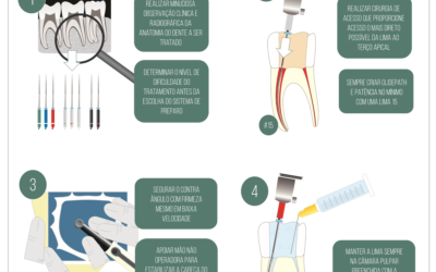 Fratura de lima endodôntica. Guia de prevenção de .