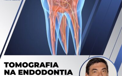 Tomografia cone beam na Endodontia, presencial em Porto Alegre.