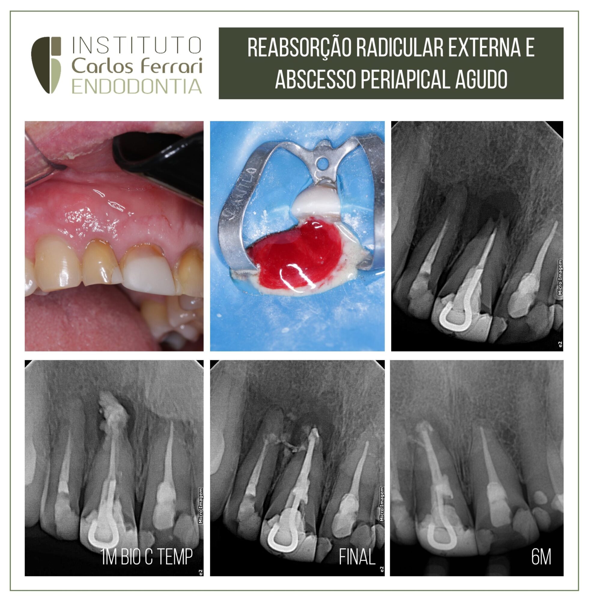 Abscesso periapical agudo.
