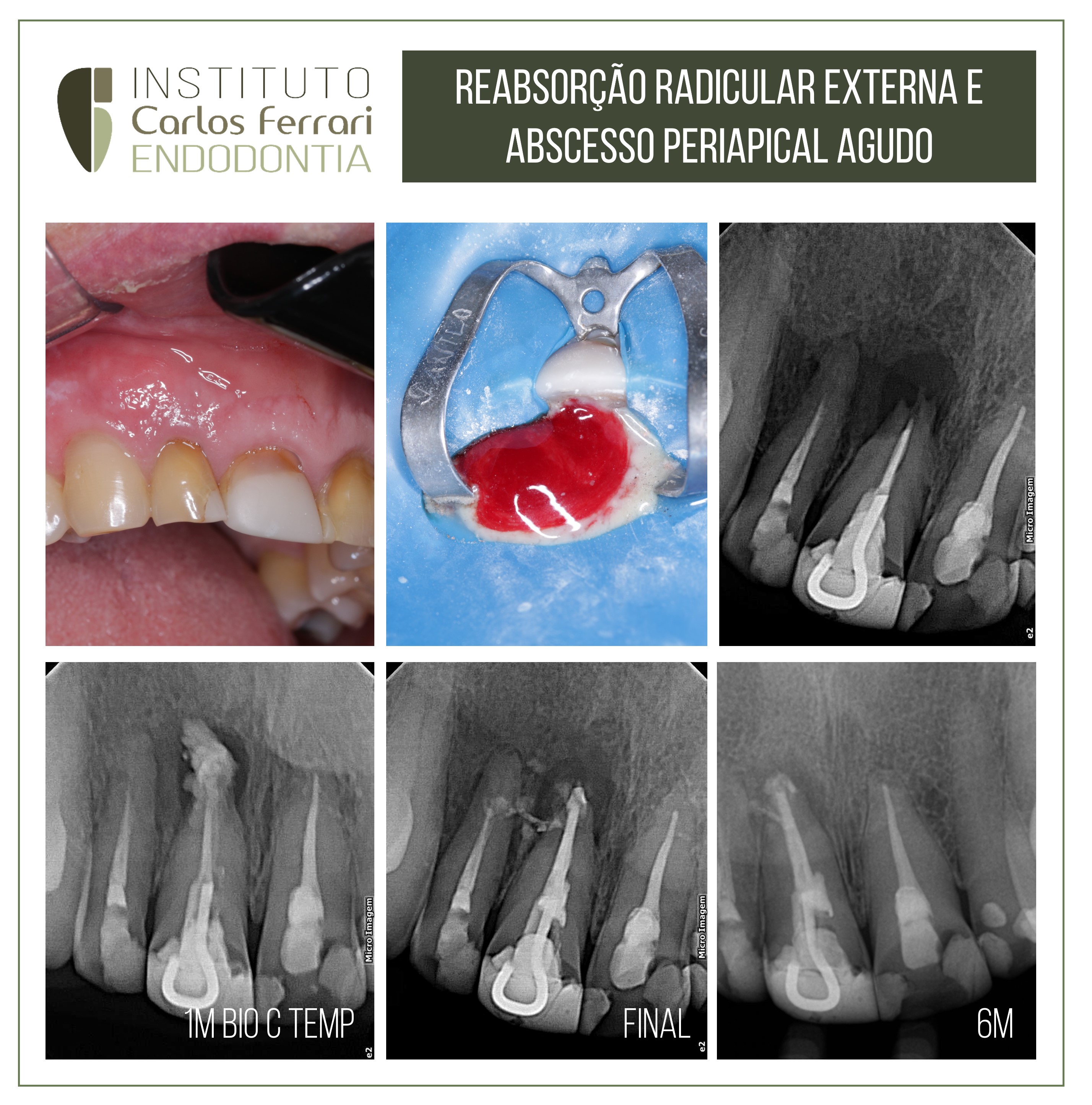 Abscesso periapical agudo.