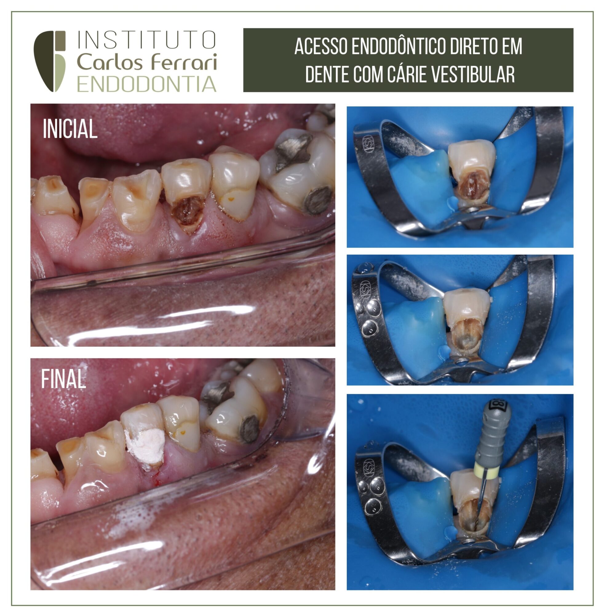 Cirurgia de acesso direto em dente com cárie vestibular.