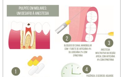 Anestesia odontológica. Anestesia em pulpite de molares.