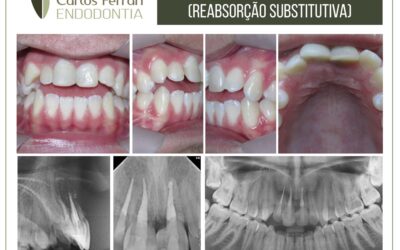 Anquilose dentária múltipla em paciente com histórico de trauma.
