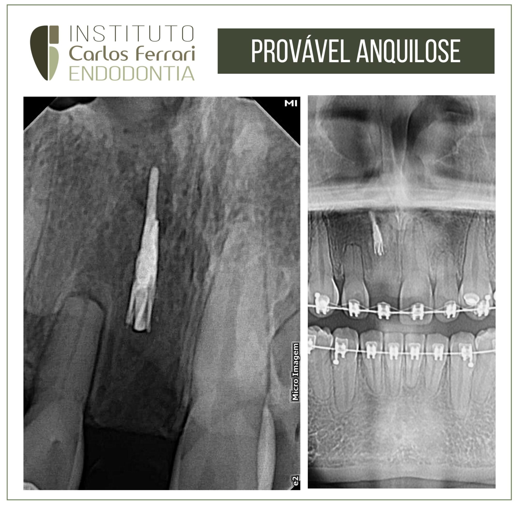 Anquilose. Provável reabsorção substitutiva.