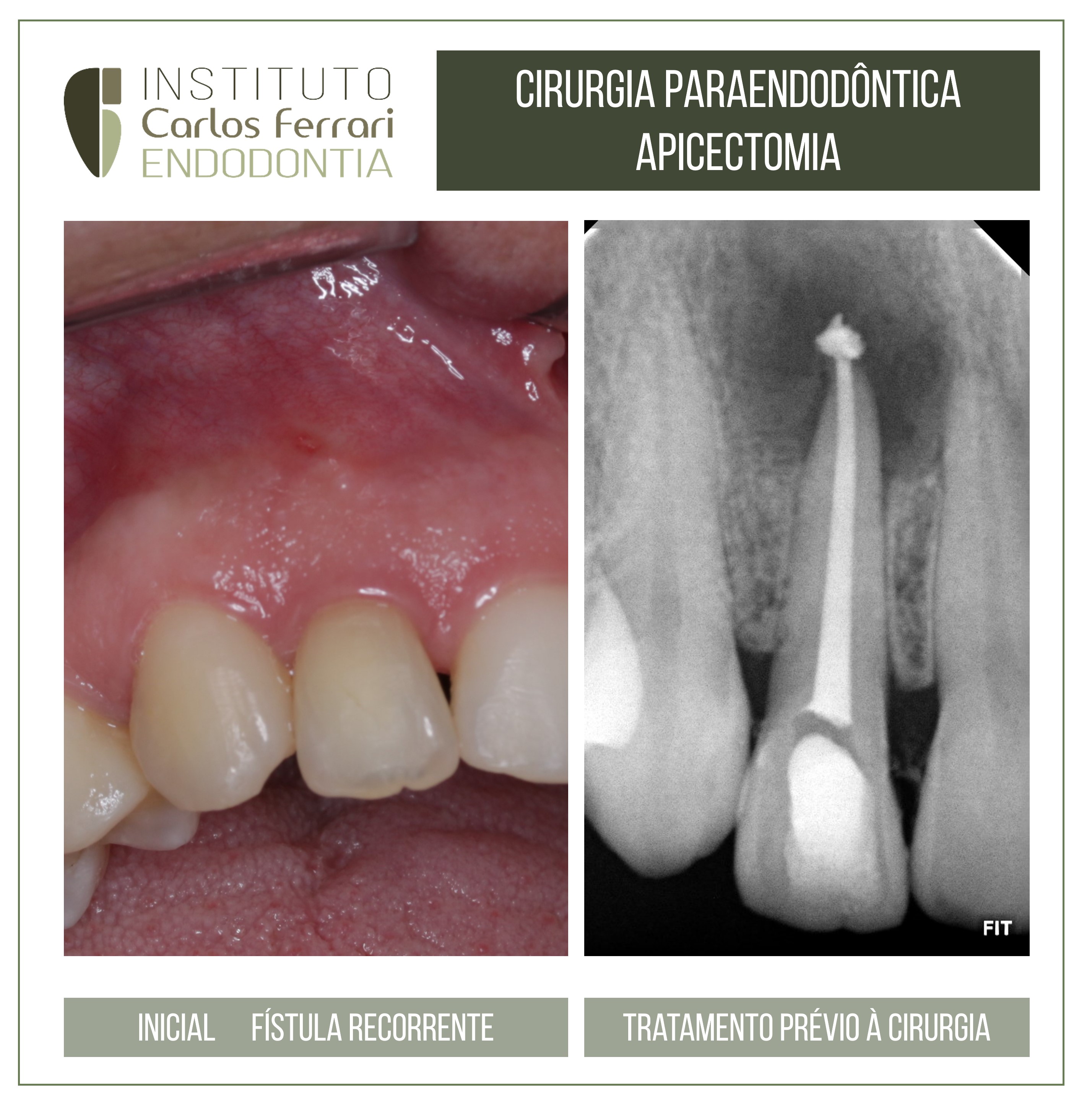 Apicectomia em cirurgia paraendodôntica.