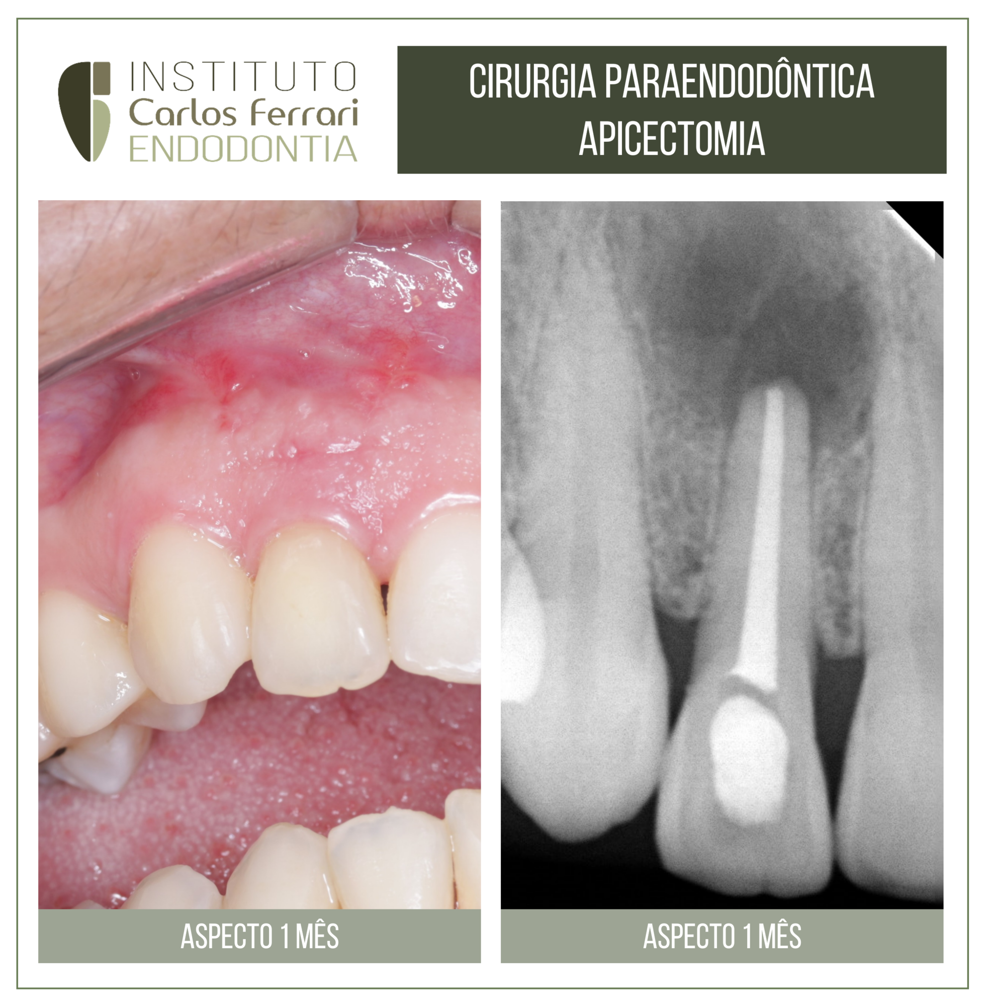 Apicectomia em cirurgia paraendodôntica.