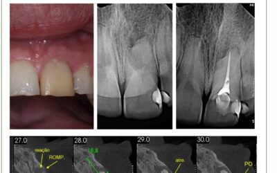 Reabsorção externa e calcificação. Relato de caso.