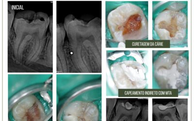 Capeamento pulpar indireto com biocerâmico em rizogênese incompleta.