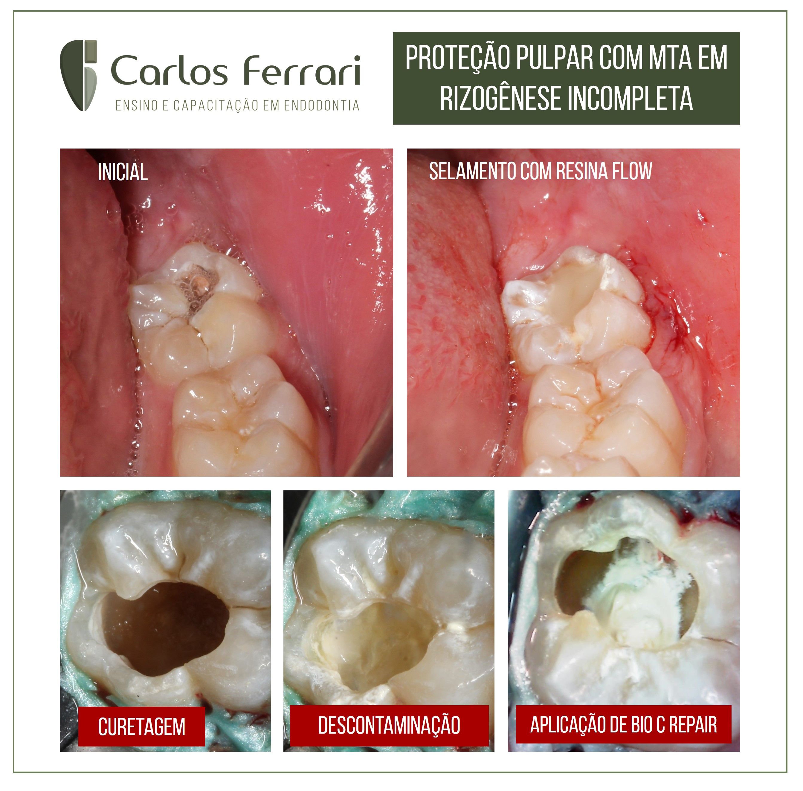 Proteção pulpar direta com biocerâmico em rizogênese incompleta.