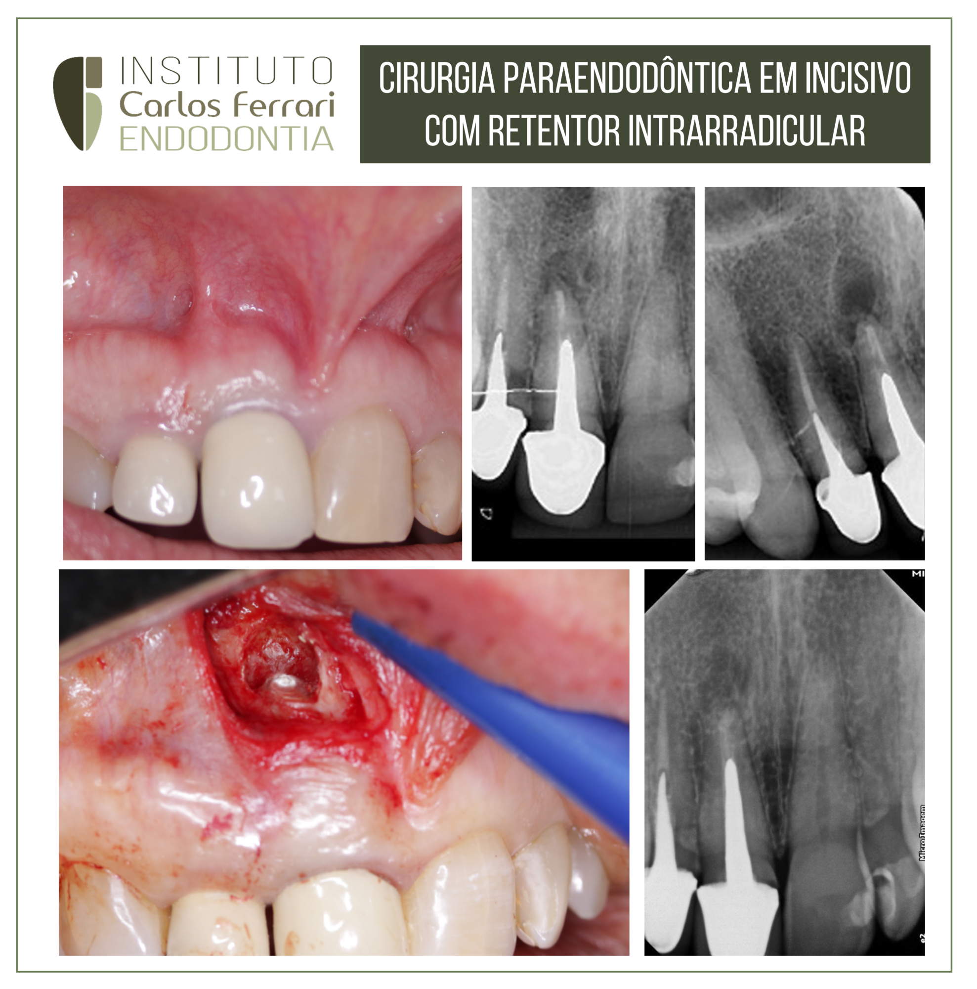 Cirurgia paraendodôntica em dente com retentor intrarradicular.