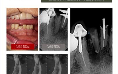 Cirurgia paraendodôntica incisivo inferior com perfuração.