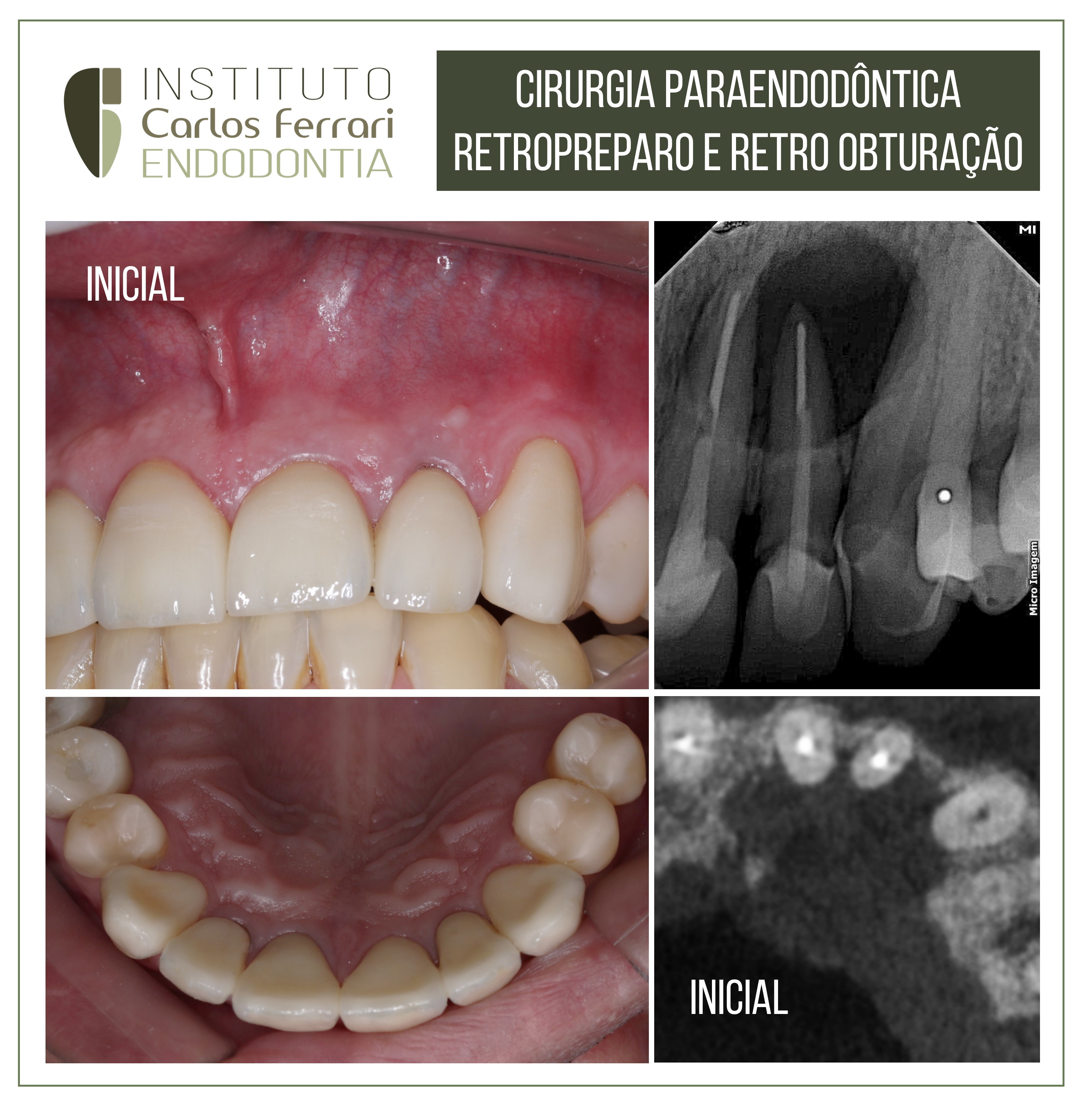 Cirurgia paraendodôntica retropreparo.