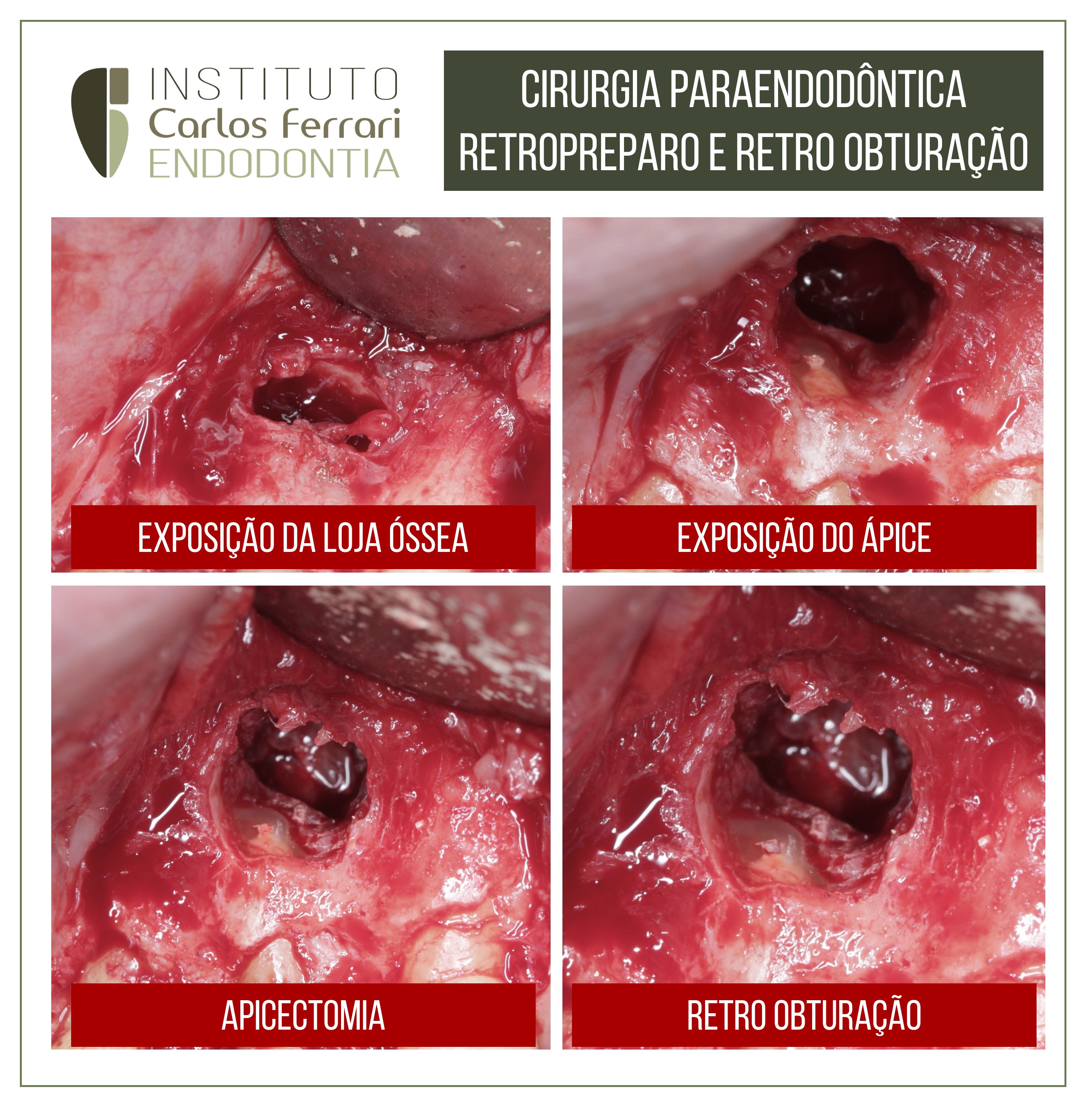 Cirurgia paraendodôntica retropreparo.