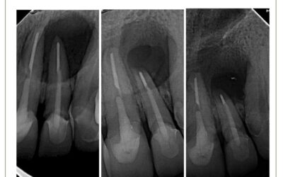 Cirurgia paraendodôntica retropreparo.