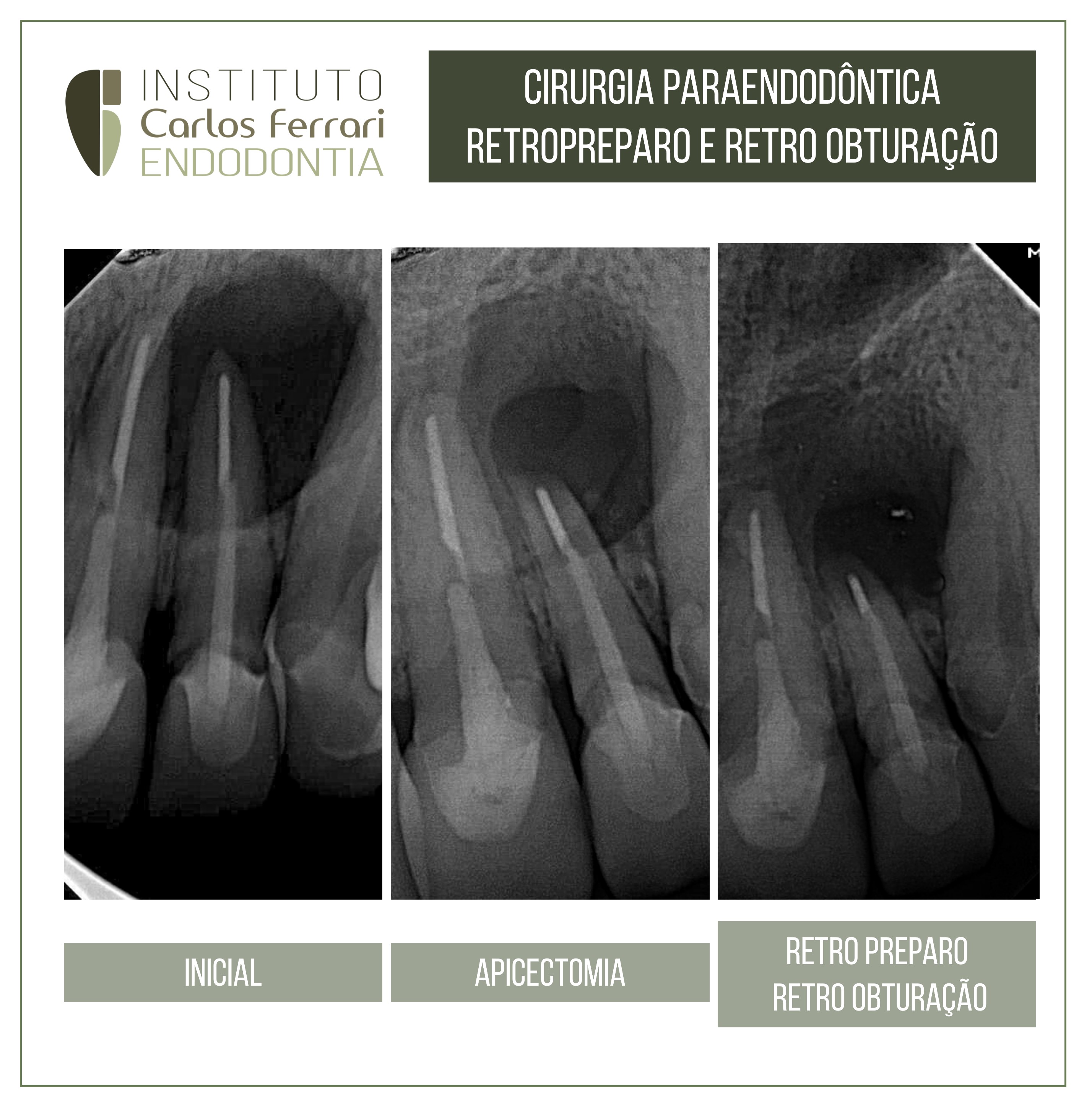 Cirurgia paraendodôntica retropreparo.