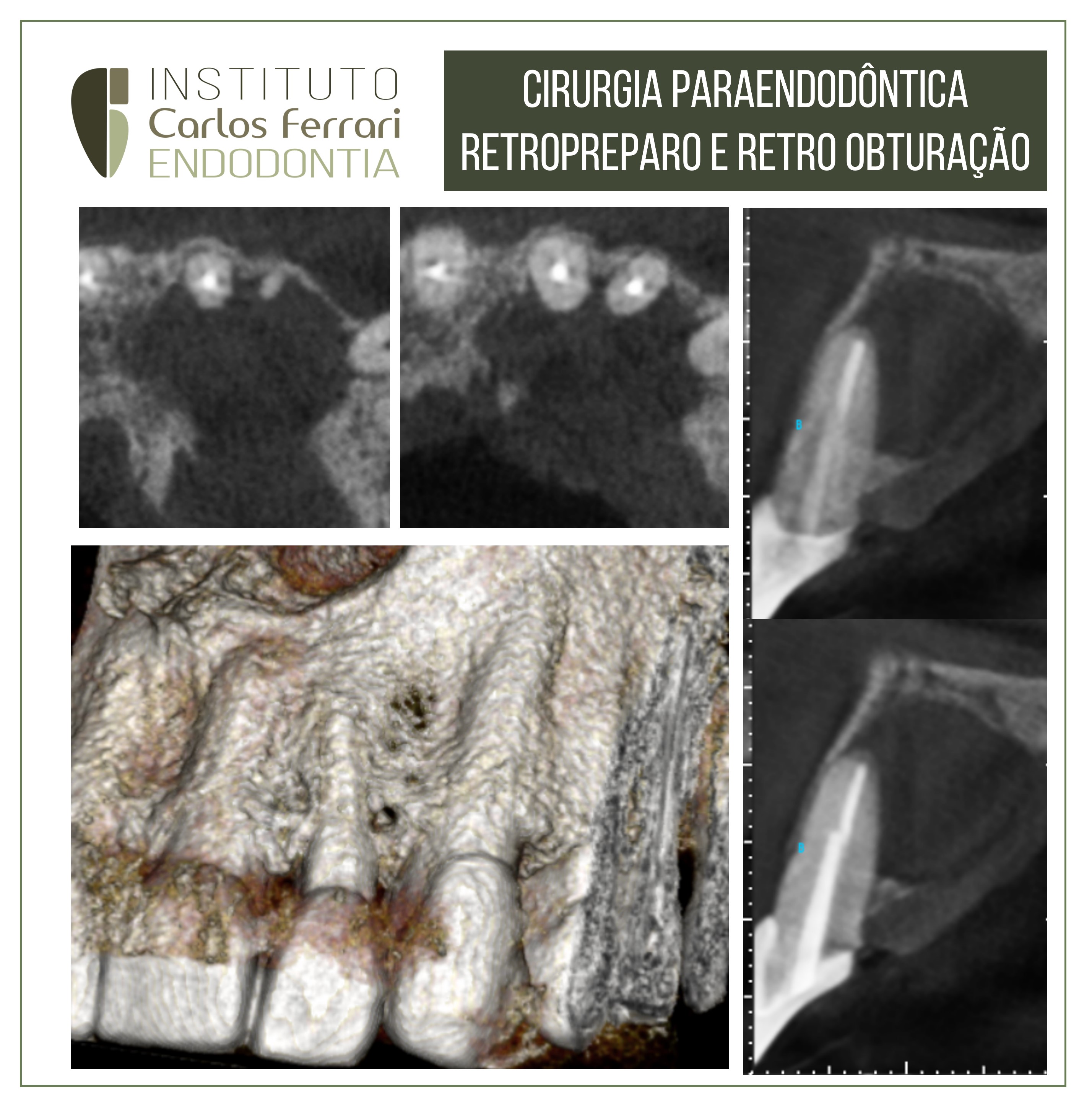 Cirurgia paraendodôntica retropreparo.