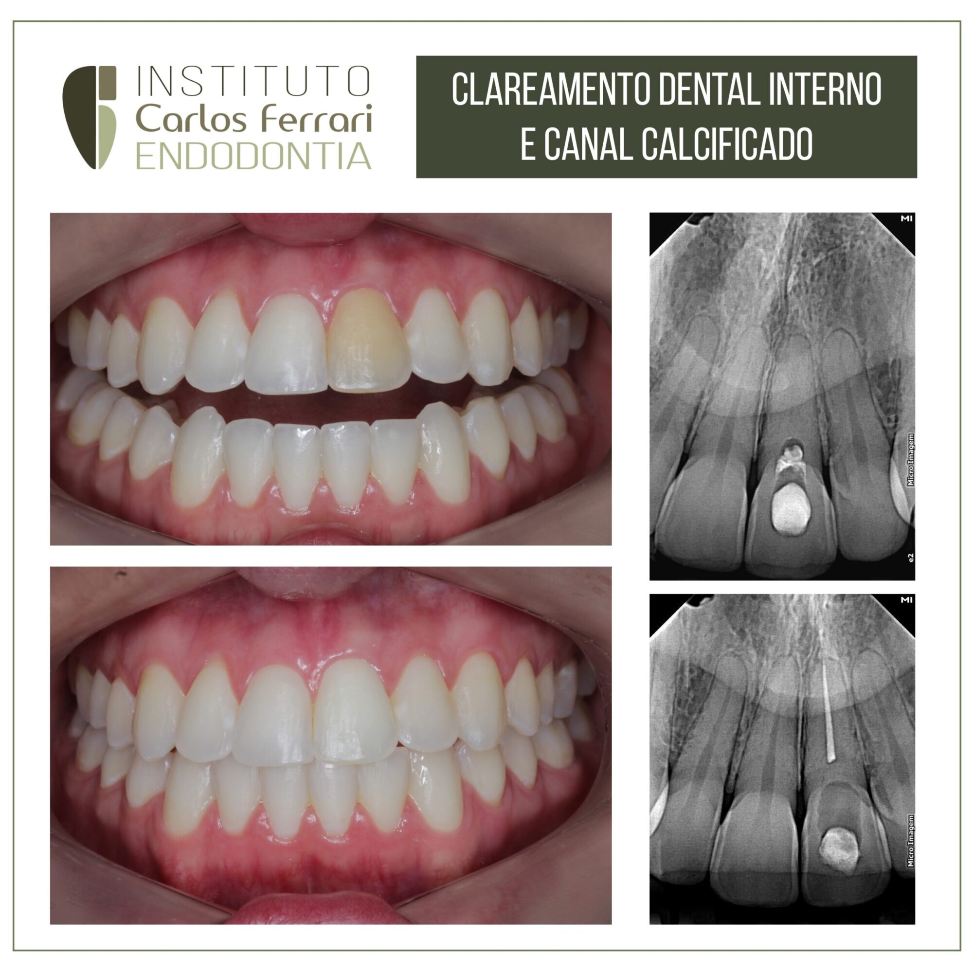 Clareamento dental interno e canal calcificado.