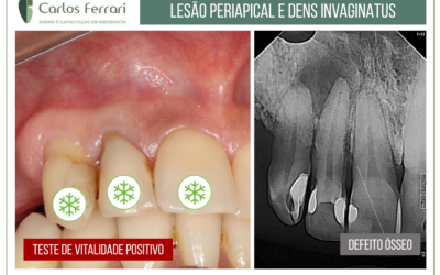 Lesão periapical e dens invaginatus.