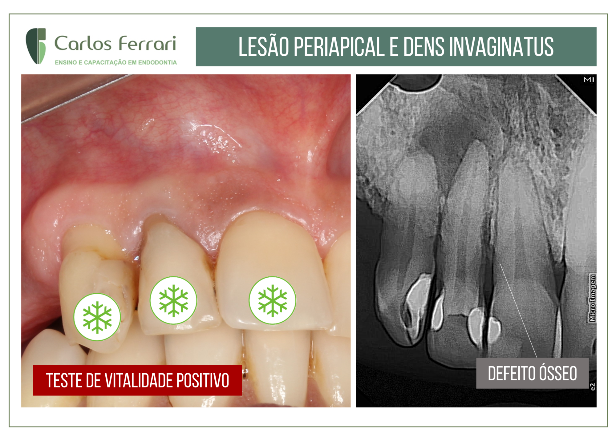 Lesão periapical e dens invaginatus.