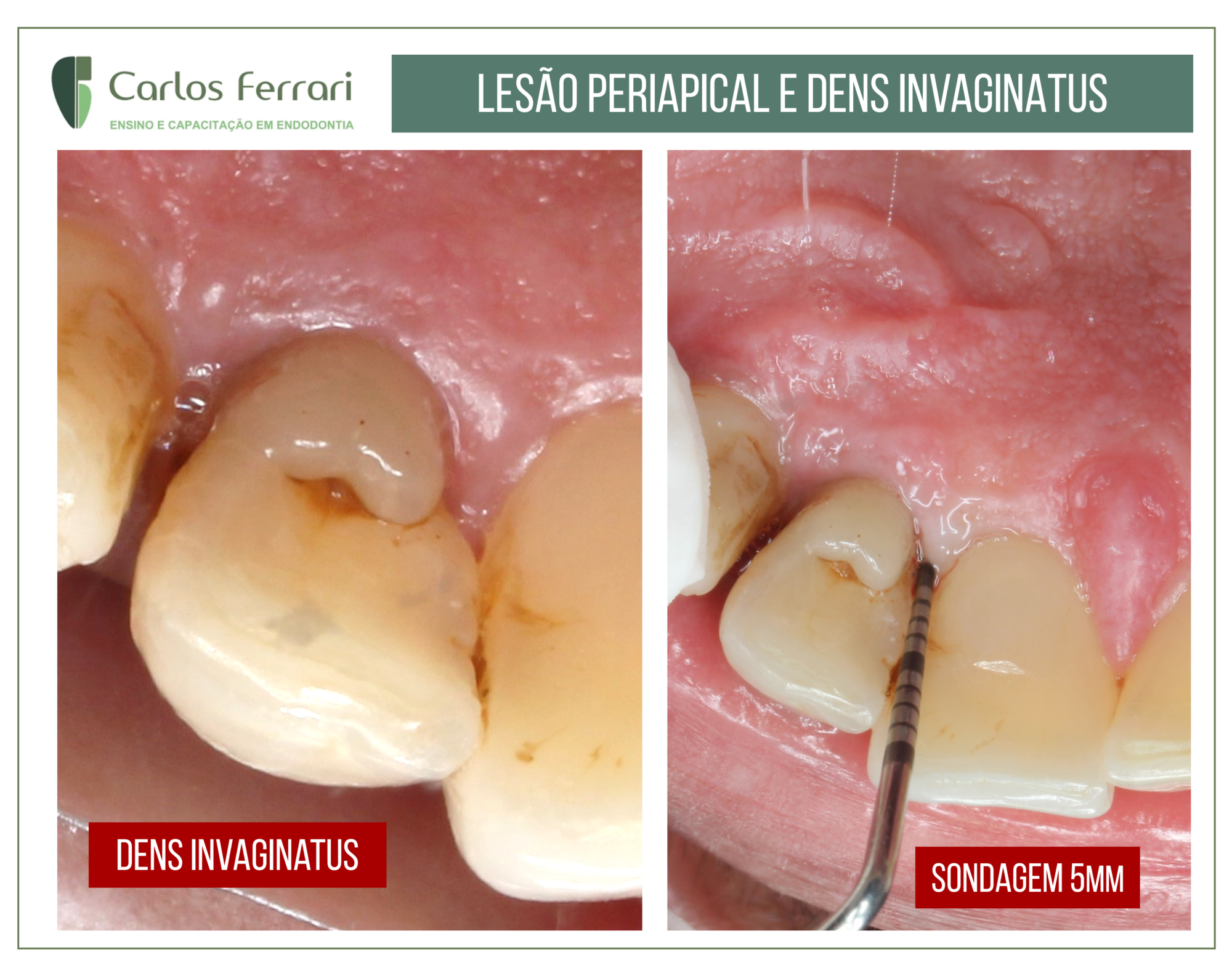 Lesão periapical e dens invaginatus.