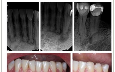 Displasia cementária periapical. Relato de caso.