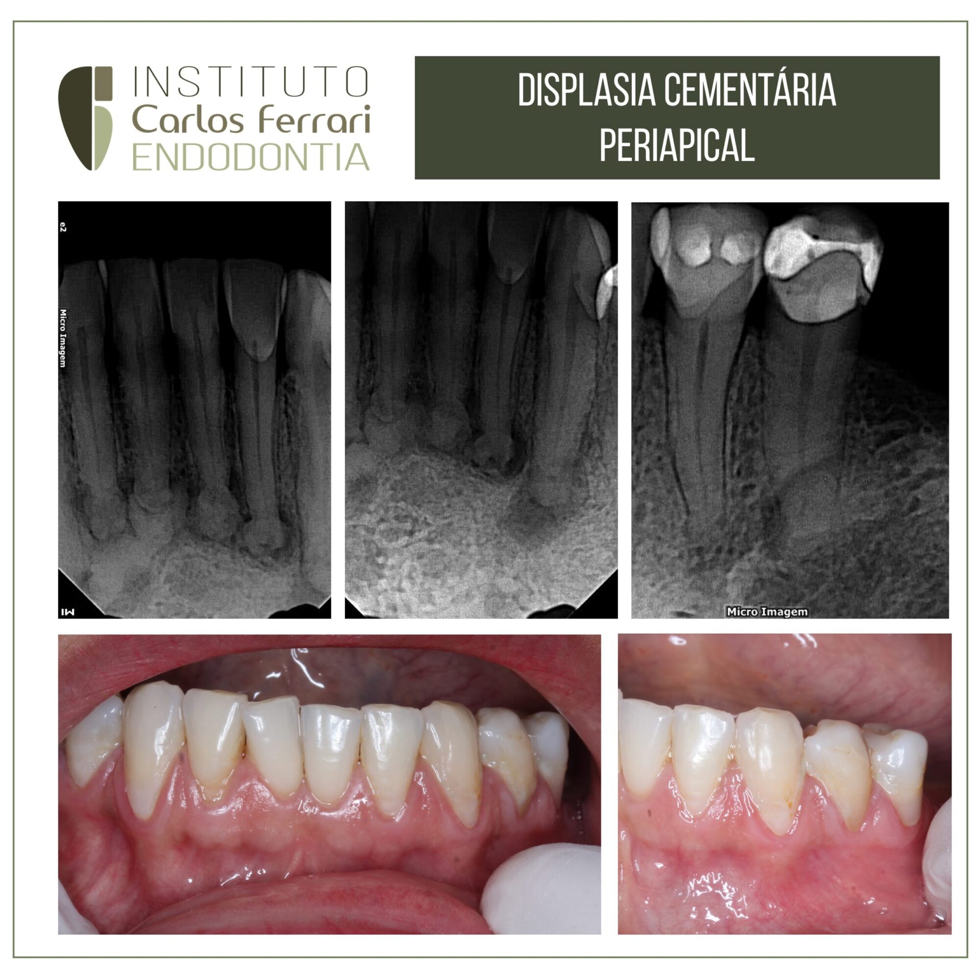 Displasia cementária periapical. Relato de caso.