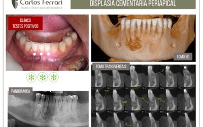 Displasia cementária periapical. Relato de caso.
