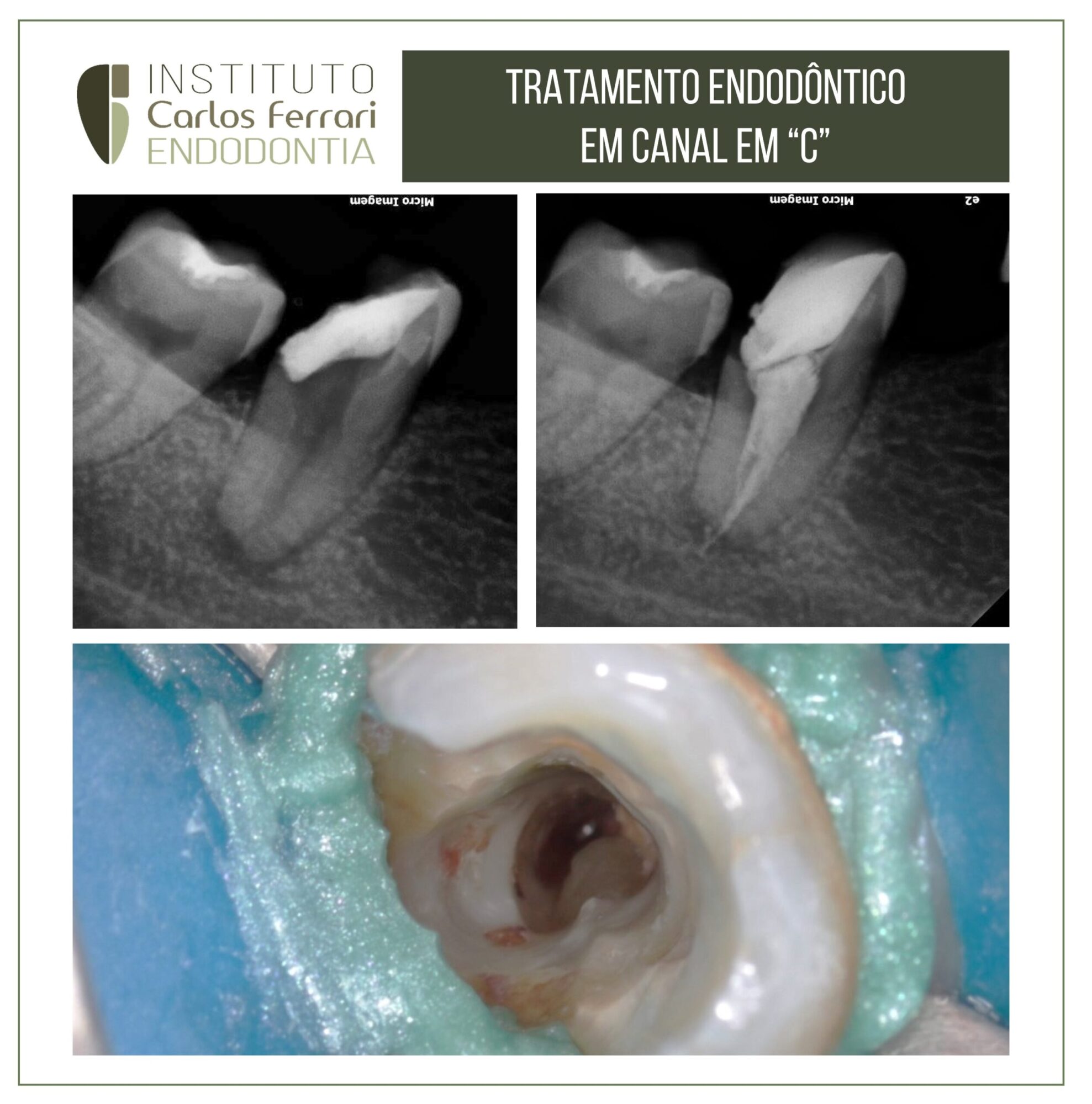 Tratamento endodôntico em molar em C. Anatomia na endodontia.