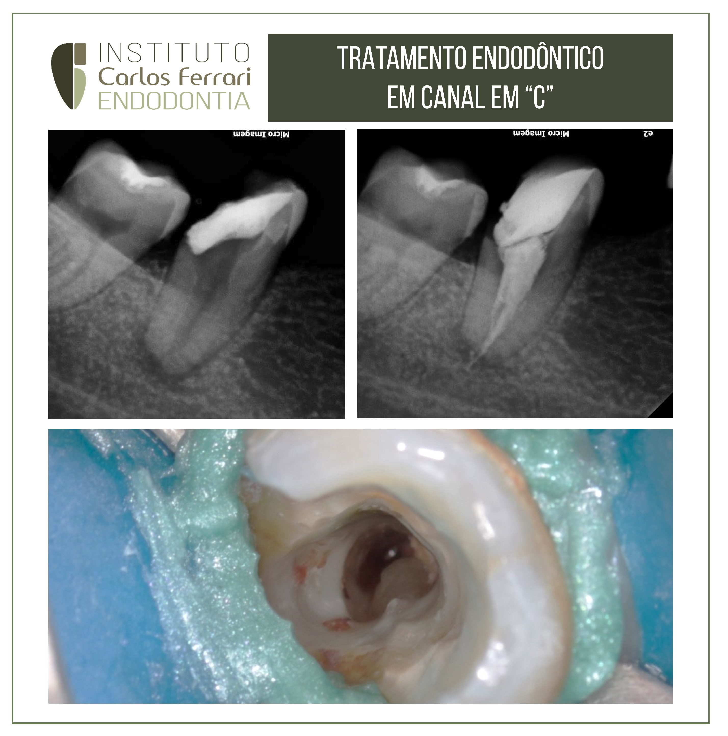 Tratamento endodôntico em molar em C. Anatomia na endodontia.