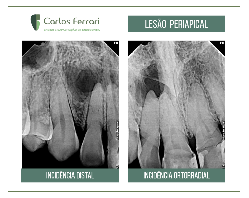 Tratamento endodôntico conservador em caso com lesão periapical extensa