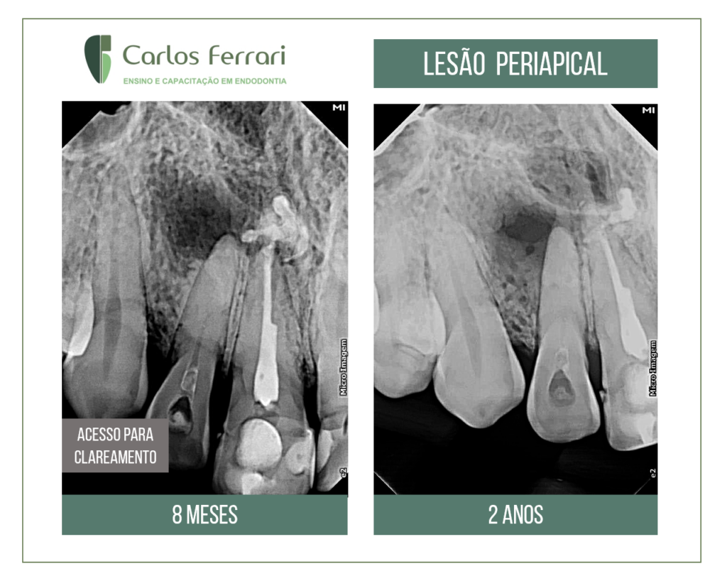 Tratamento endodôntico conservador em caso com lesão periapical extensa