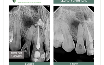 Tratamento endodôntico conservador em caso com lesão periapical extensa