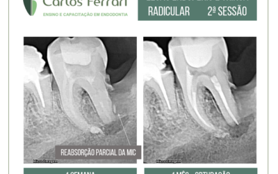 Lesão endoperio. Molar inferior com pulpite.