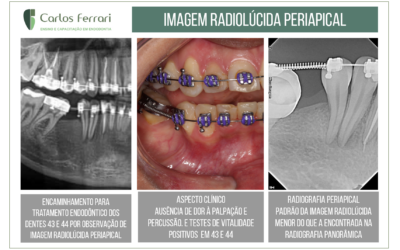 Imagem radiolúcida em paciente em tratamento ortodôntico. Falsa lesão periapical.