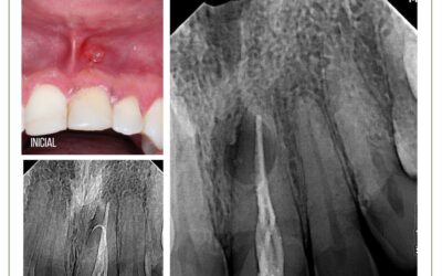 Forame incisivo e abscesso apical crônico. Relato de caso.
