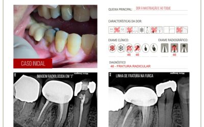 Fratura radicular em molar inferior