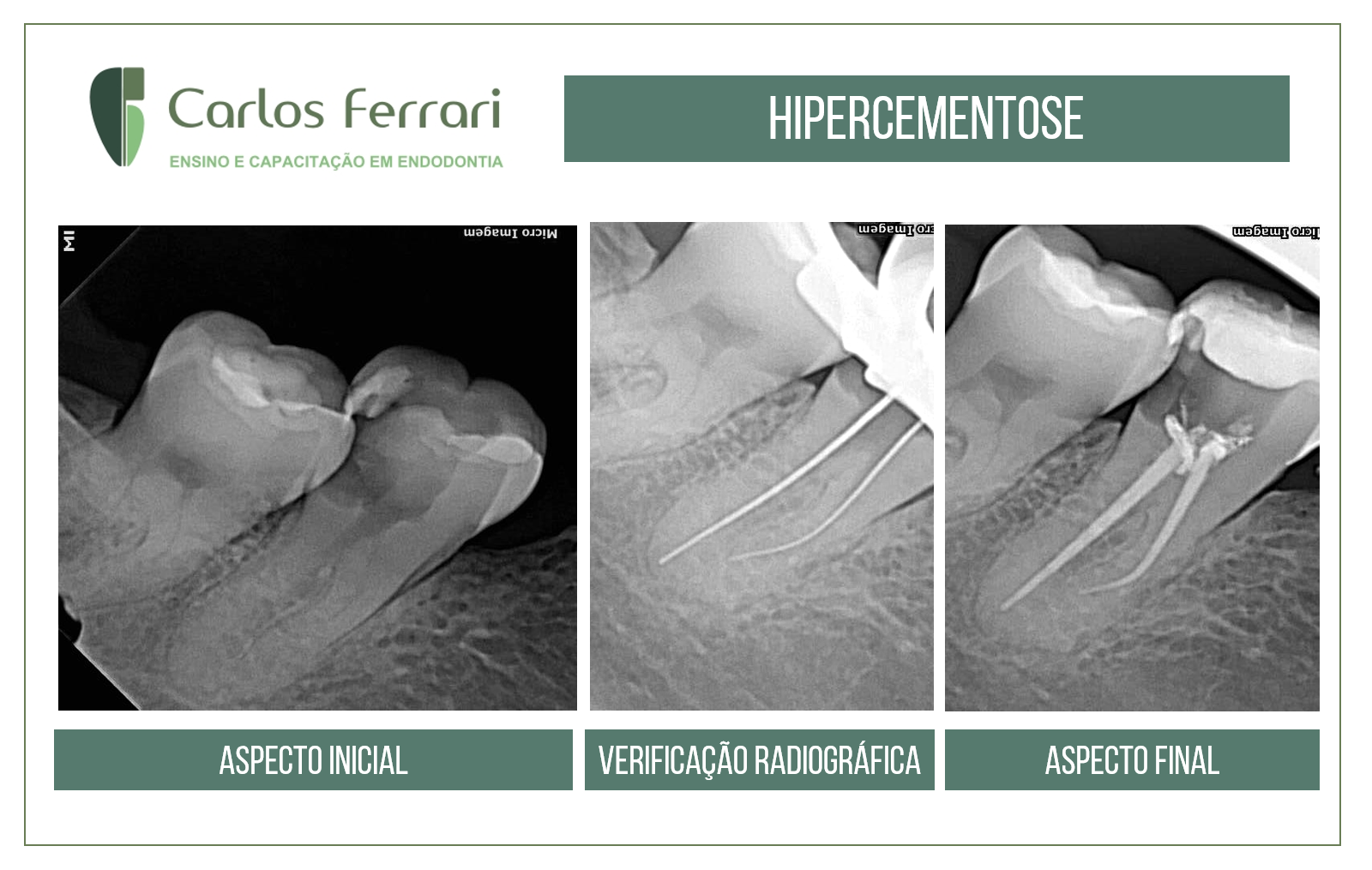 Tratamento endodôntico e hipercementose
