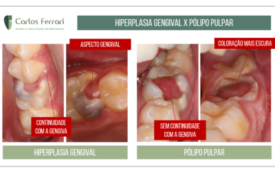Pólipo pulpar ou hiperplasia gengival