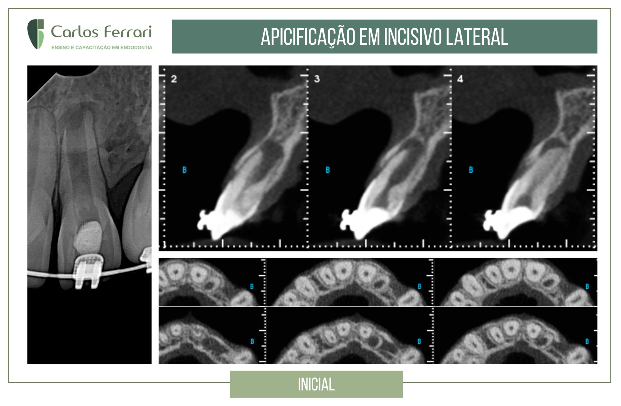 Apicificação em dente com rizogênese incompleta.