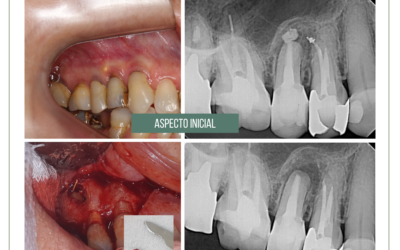 Cirurgia paraendodôntica