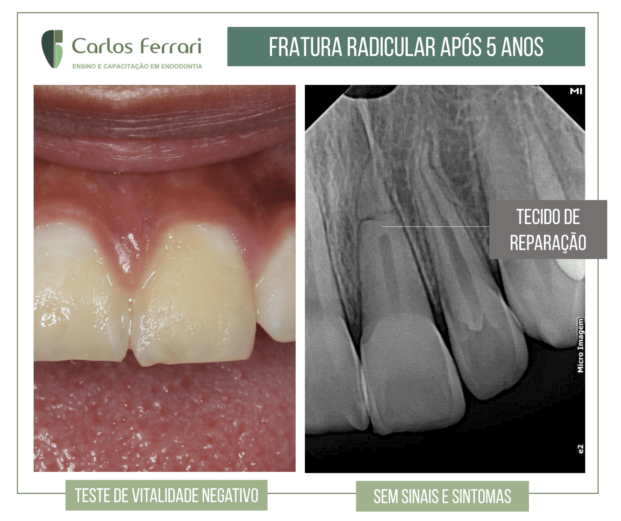 Fratura radicular com acompanhamento de 5 anos. Fratura radicular com acompanhamento de 5 anos.