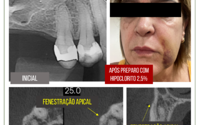 Irrigação na endodontia. Acidente com hipoclorito e clorexidina.