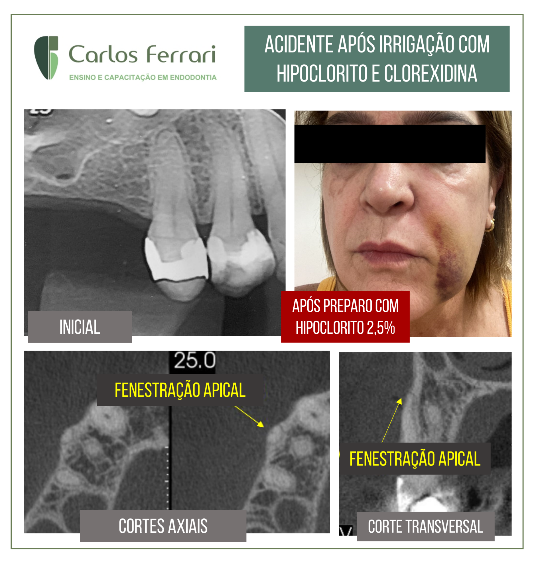 Irrigação na endodontia. Acidente com hipoclorito e clorexidina.