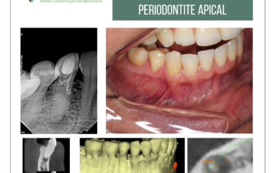 Perfuração, canal radicular obliterado e periodontite apical assintomática.